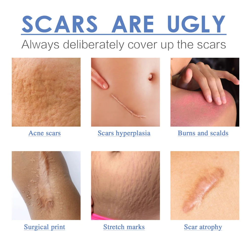 SOUTH MOON Silicone Scar Removal Sheets 4 x 150cm Surgical Scar Treatment Waterproof Breathable Scar Therapy Patches - 4