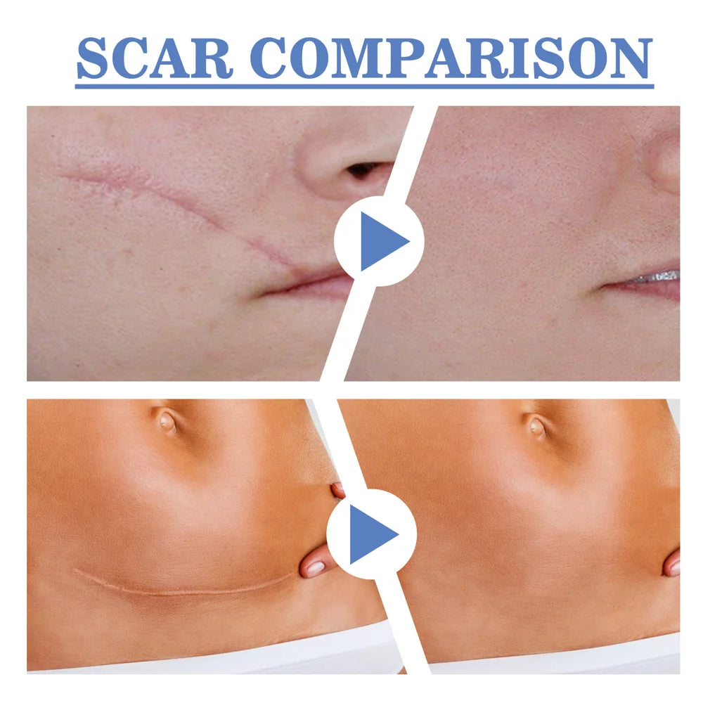SOUTH MOON Silicone Scar Removal Sheets 4 x 150cm Surgical Scar Treatment Waterproof Breathable Scar Therapy Patches - 7