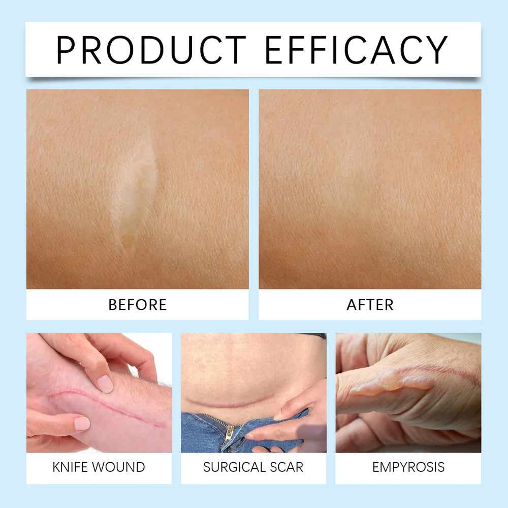 LANISKA Silicone Scar Sheet Reusable Breathable Scar Fading Strips for Surgical Scars, Keloid, C-Section - 7
