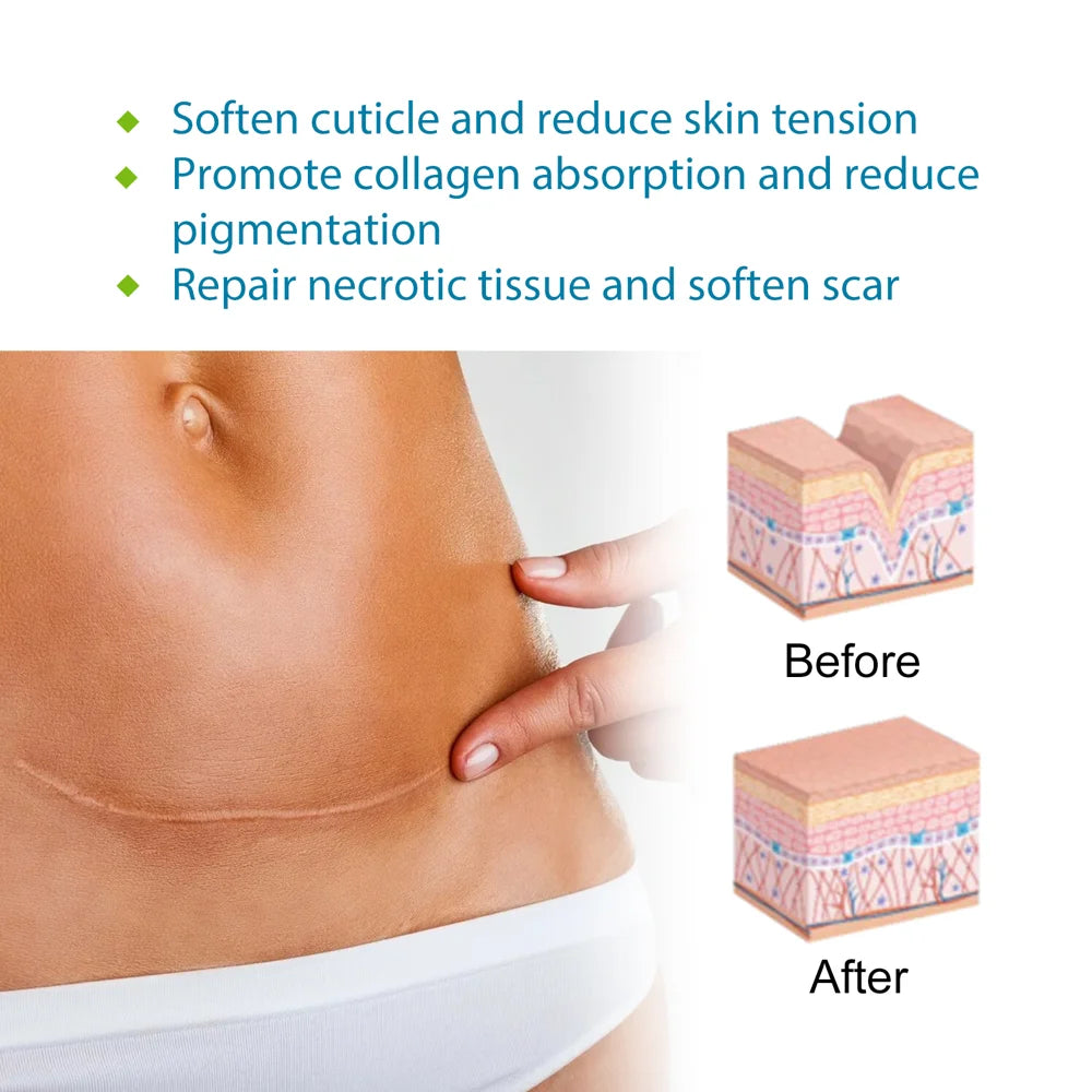 WEST&MONTH Silicone Scar Sheets Self-Adhesive Scar Tapes for Stretch Marks / Skin Repair / Smooth Skin Care - 4