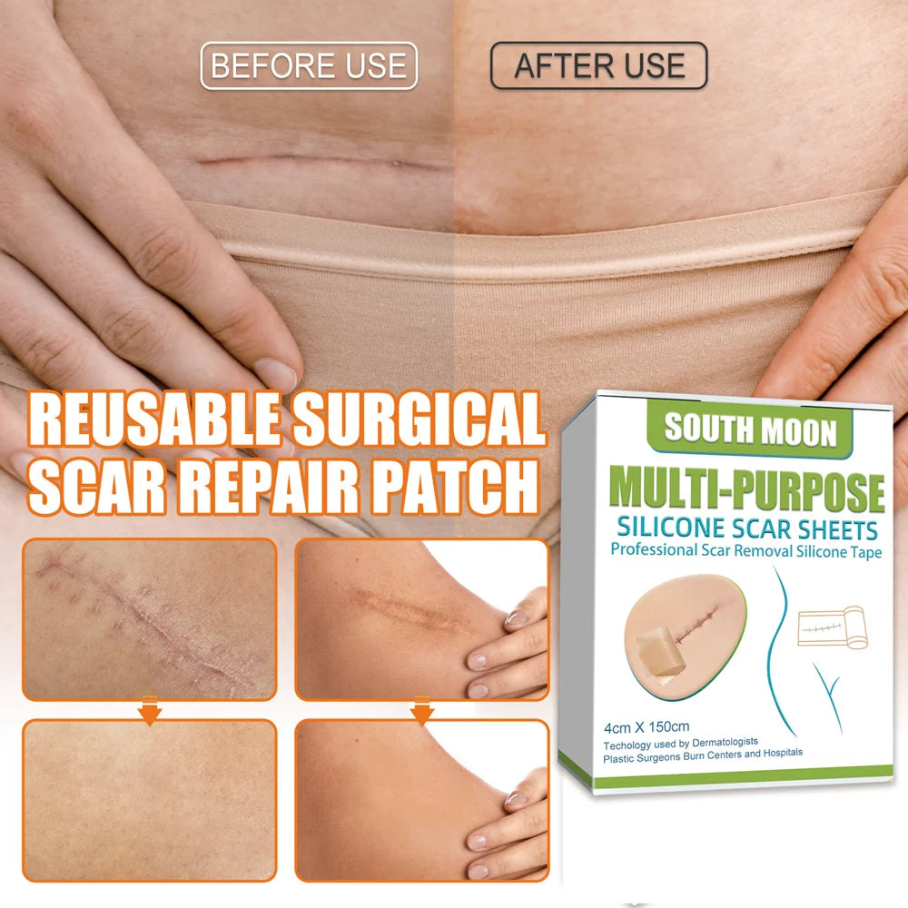 SOUTH MOON Silicone Scar Sheets Medical-Grade Scar Removal Patches Skin Repair Treatment for Post Surgery Acne Marks - 6