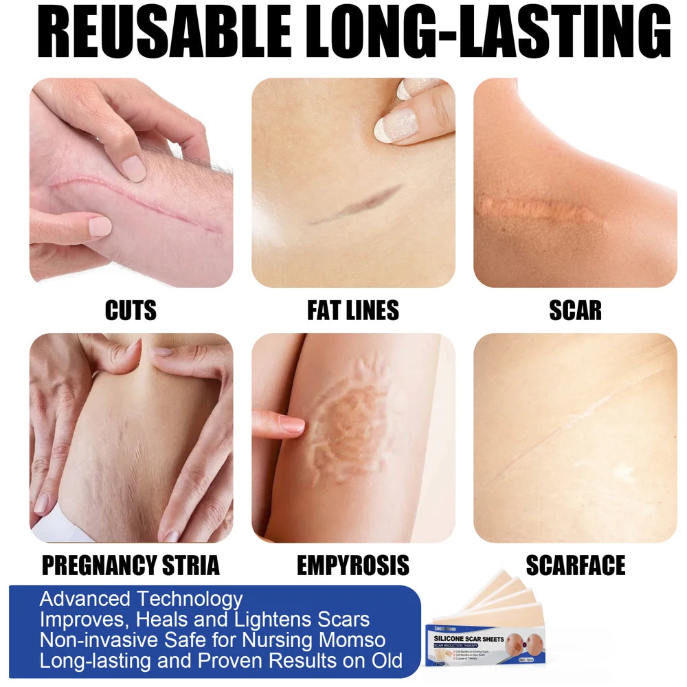 SOUTH MOON 4Pcs Silicone Scar Sheets Self Adhesive Burn Wound Healing Skin Smoothing Patches - 7