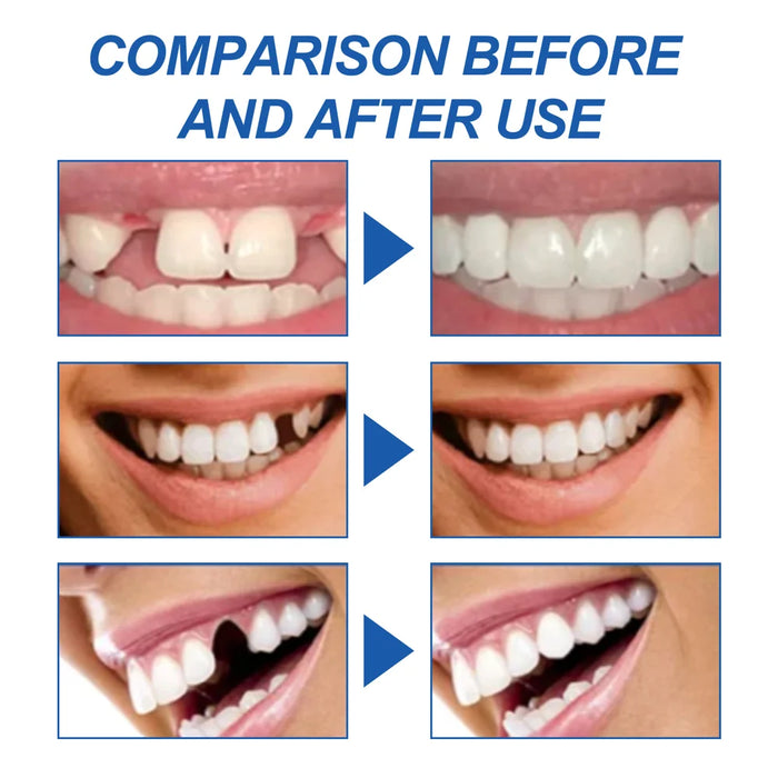 SOUTH MOON 30ml Temporary Teeth Replacement Filling Kit Moldable False Teeth Beads for Missing, Cracked DIY Denture - 7