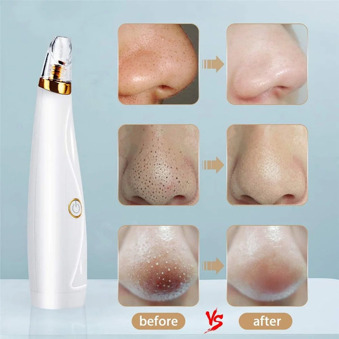 Blackhead Remover Vacuum Pore Cleaner Pimple Extractor Acne Removal Kit with 3 Replaceable Heads and 5 Needles - 3