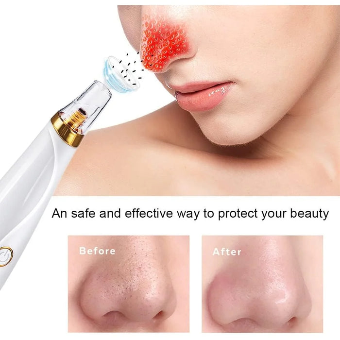 Blackhead Remover Vacuum Pore Cleaner Pimple Extractor Acne Removal Kit with 3 Replaceable Heads and 5 Needles - 5