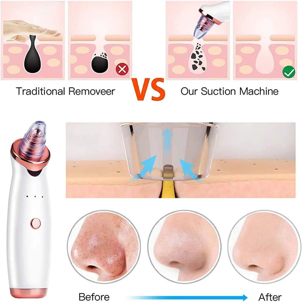 USB Rechargeable Pore Cleanser 3 Suction Levels Blackhead Extractor with 5 Heads Skin Care Tool - 7