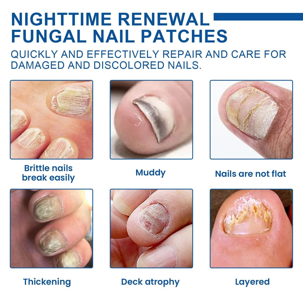 XIMONTH XIB05-A006-32-BU1 32Pcs Fungal Nail Patches Ingrown Toenail Overnight Repair Treatment - 3