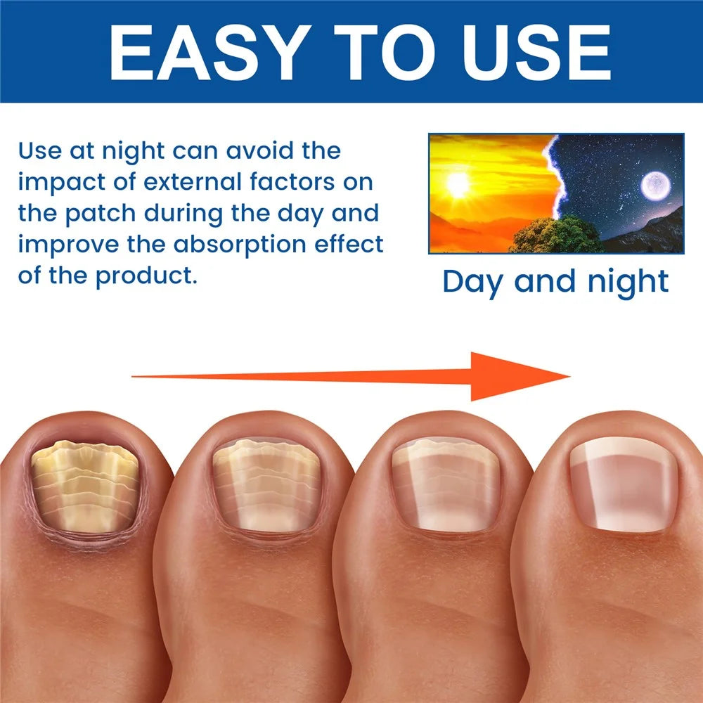 XIMONTH XIB05-A006-32-BU1 32Pcs Fungal Nail Patches Ingrown Toenail Overnight Repair Treatment - 7