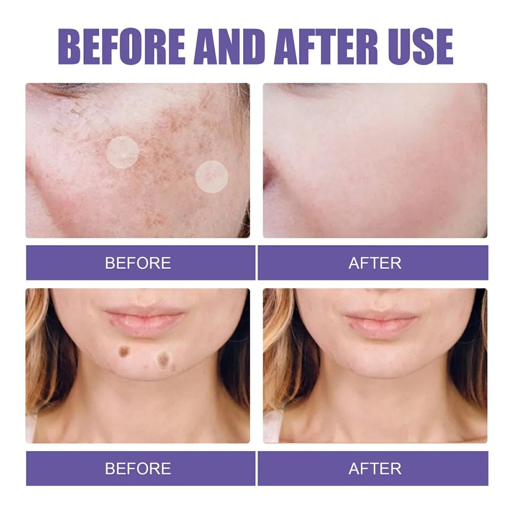 EELHOE 144Pcs Spot Treatment Patches Dark Spot Remover Skin Brightening Stickers, EEA08-A113-144-VT1 - 7