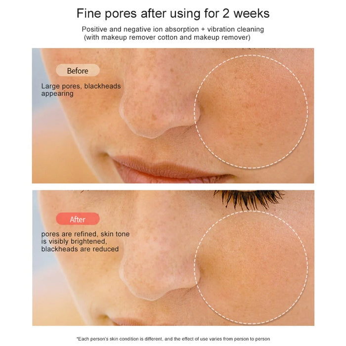 RF Face Lifting Machine EMS Pulse Therapy Device Skin Rejuvenation Micro Current Wrinkle Remover - Champagne - 4