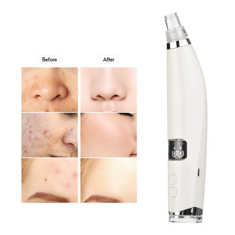 Blackhead Comedones Whitehead Pore Vacuum Cleaner Remover with Hot Compress Function with USB Cable for Women Men - 4